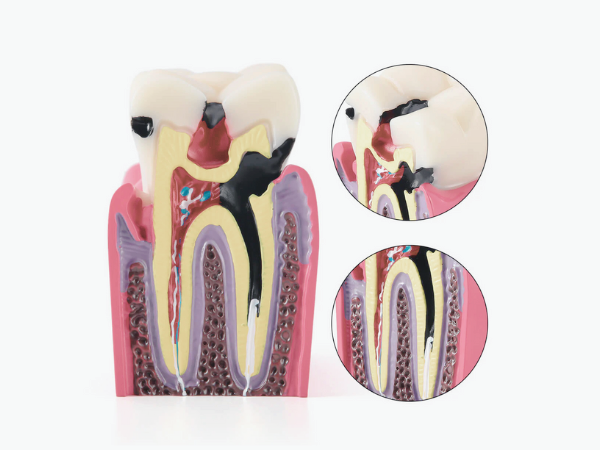 마곡역치과_ 1. 글래스아이오노머(GI) 특징과 장단점 관련 이미지 1