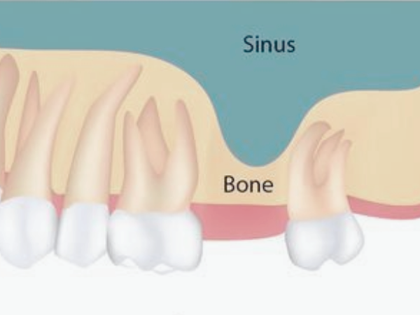마곡역치과_1. 상악동거상술이란? 위턱 임플란트 전 꼭 알아야 할 정의와 적응증 관련 이미지 4