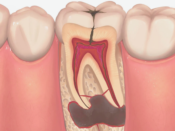 마곡동치과_&ldquo;그냥 두면 괜찮을 줄 알았죠?&rdquo; [3. 치근단절제술 미루면 생기는 문제] 관련 이미지 3