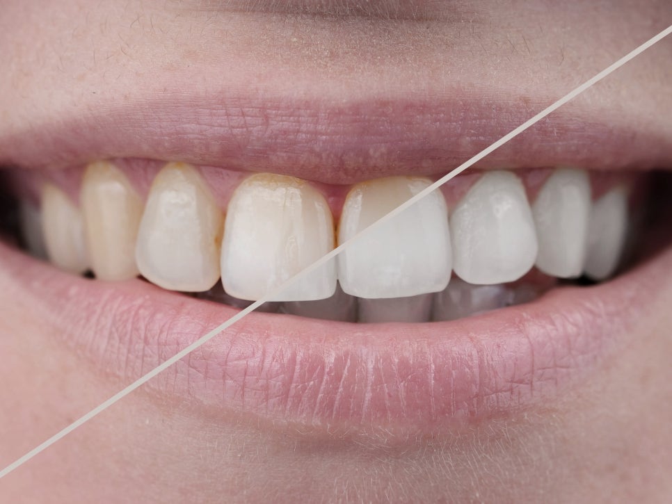 마곡동치과_전문가 미백 관련 이미지 8