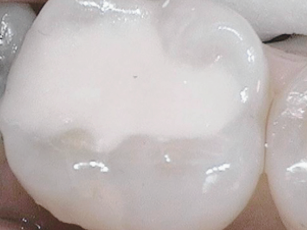 마곡역치과_ 1. 글래스아이오노머(GI) 특징과 장단점 관련 이미지 8