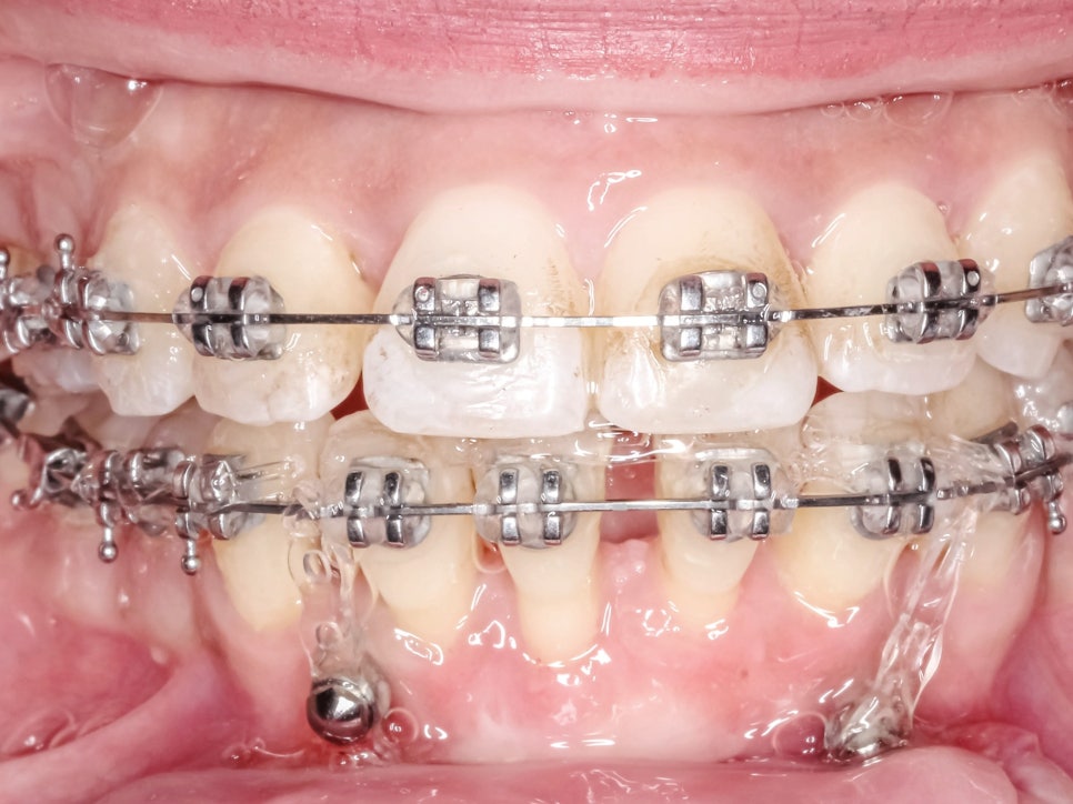 Magaok Station Dental Clinic_ “Why Do Gums Recede?” [1. Causes of Gingival Recession] image 4