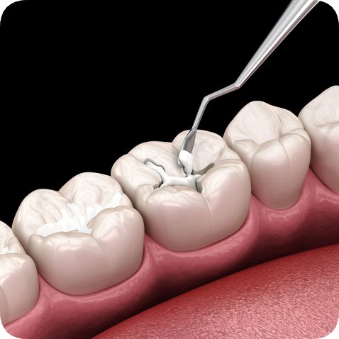마곡동치과_"방치하면 임플란트까지?" [ 3. 충치 진행 단계별 치료 ] 관련 이미지 3