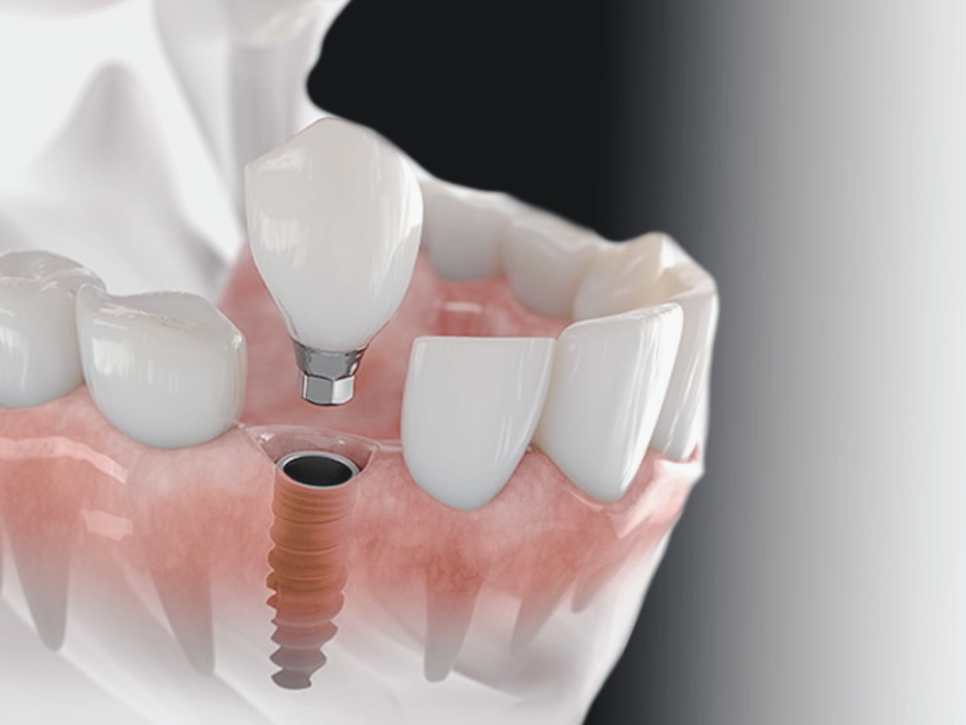 마곡역치과_"씹는 즐거움, 웃는 자신감, 내 이 같은 자연스러움" [ 3. 임플란트 수술과정 ] 관련 이미지 1