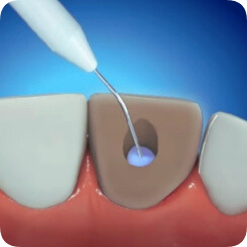 마곡역치과_ &ldquo;죽은 치아도 다시 하얘진다!&rdquo; [4. 실활치 미백치료 특징과 과정] 관련 이미지 5