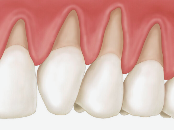Maggok-dong Dental Clinic_“Signs That Your Gums Are Receding” [2. Step-by-Step Progression of Gingival Recession and Self-Diagnosis Checklist] image 3