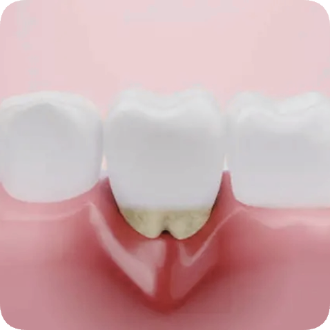 마곡역치과_ 충치, 풍치, 외상으로 치아 빠졌다면? [ 2. 임플란트가 필요한 경우 ] 관련 이미지 2