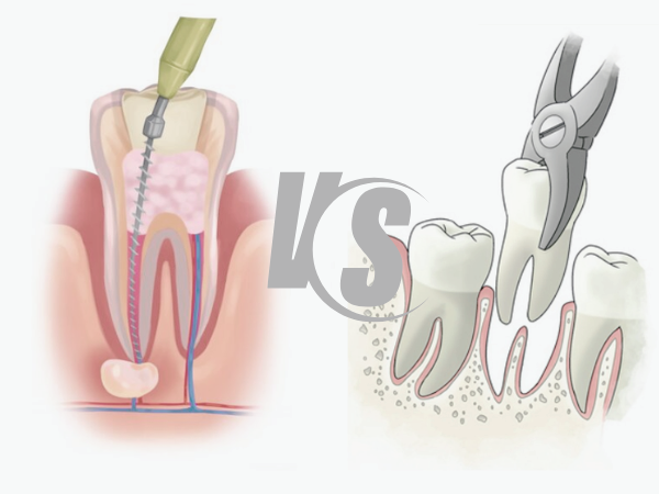 마곡치과_4. 신경치료 후 통증, 재신경치료와 발치 어떤 선택이 맞을까요? 관련 이미지 1