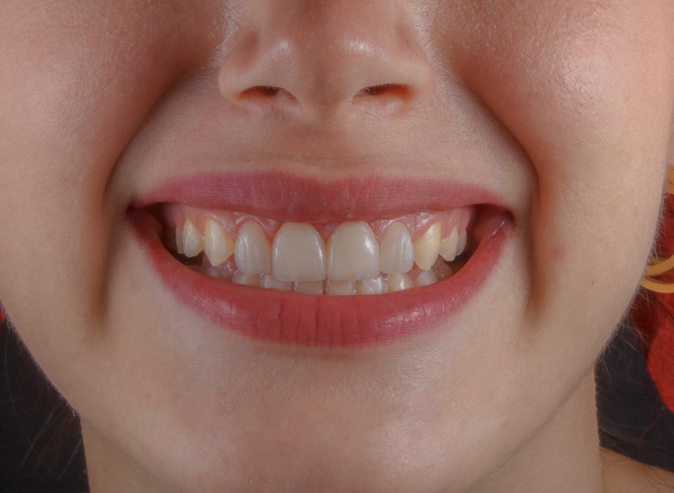 [ Magok Laminate_09 ] Laminate Veneers: These Misconceptions Are Common image 1