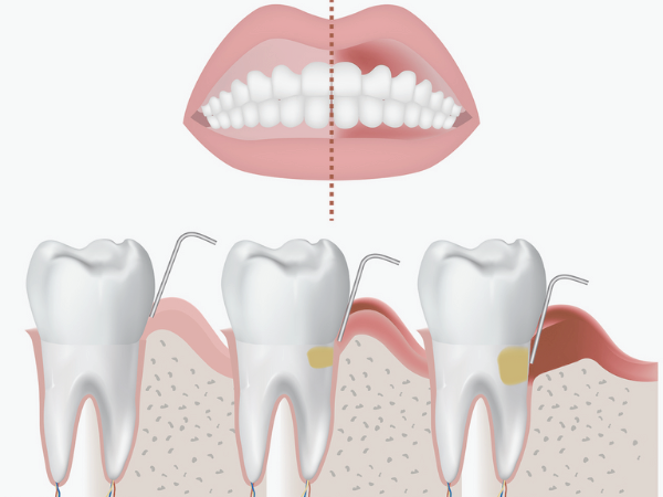 Maggok Dental_1. “If Your Gums Bleed When You Brush Your Teeth?” Early Symptoms of Gingivitis and Self-Check Method image 5