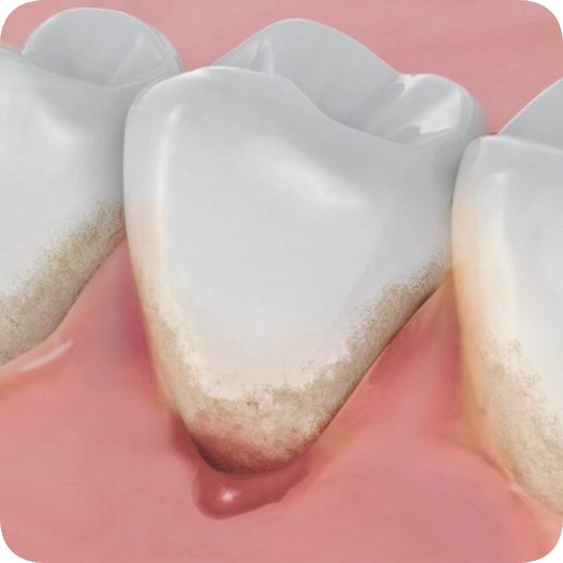 마곡동치과_3. 치주질환 자가진단 체크! 내 잇몸은 안전할까? 관련 이미지 3