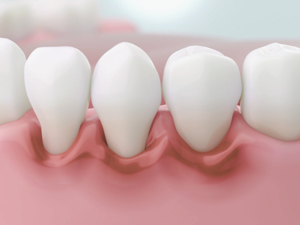 마곡역치과_"그냥 두면 어떤 문제가 생길까요?"[ 4. 치아마모 방치 시 문제점] 관련 이미지 4
