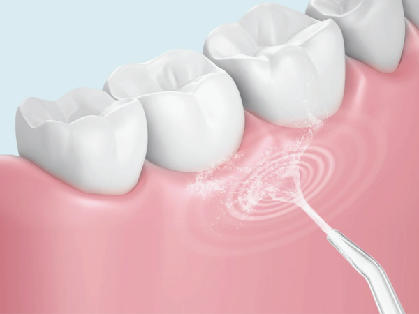 마곡역치과_ 4. 구강세정기 꼭 써야 할까요? 물치실 효과와 올바른 사용법 관련 이미지 4
