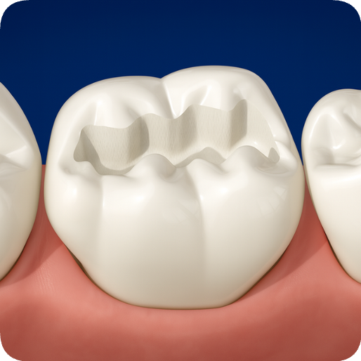 마곡역치과_ 4. 글래스아이오노머(GI) 충치 치료 과정 관련 이미지 2