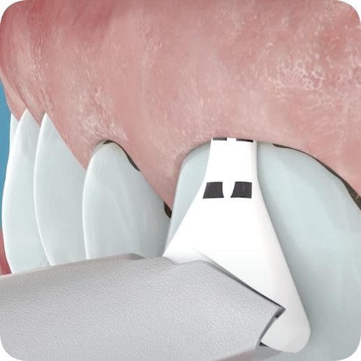 마곡역치과_&ldquo;치아가 개운해지는 6단계 여정&rdquo; [ 4.  에어플로우 스케일링 과정 ] 관련 이미지 5