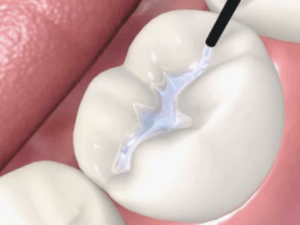 Magaok Station Dental Clinic_ “How Can Sealants Last Longer?” [4. Sealant Maintenance Guide] image 1