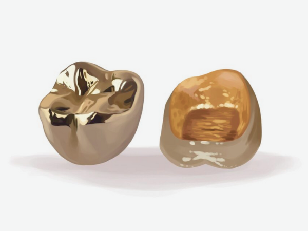 마곡동치과_2. 치과 크라운 보철의 종류별 장단점과 비용 관련 이미지 2