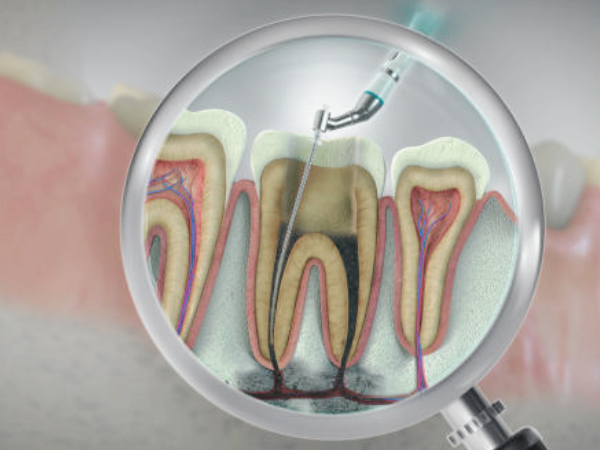 마곡역치과_5. 치수염 방치하면 어떻게 될까요? 통증 변화 과정 정리 관련 이미지 4