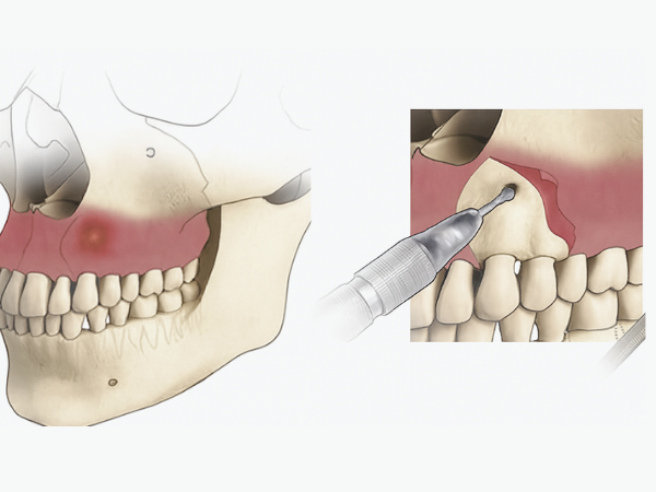 마곡동치과_&ldquo;이빨 뿌리 끝 염증, 이렇게 해결합니다!&rdquo; [2. 치근단절제술 과정] 관련 이미지 3