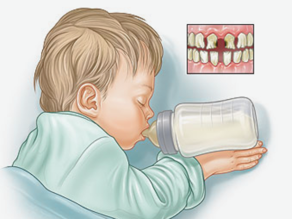 마곡동치과_1. 영유아 구강관리(0~3세), 첫 치아부터 꼭 알아야 할 관리법 관련 이미지 3