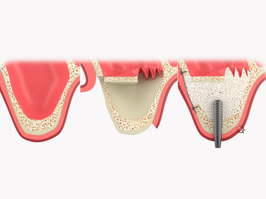 Magok Dental Clinic_ 5. A Complete Guide to Full-Mouth Implant Prices: How Much Will I Actually Pay? image 3