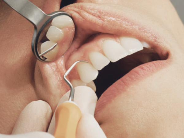 마곡역치과_5. 가글 많이 하면 더 깨끗할까? 소독 가글 올바른 사용법 관련 이미지 2