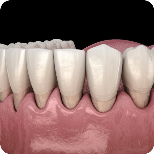 마곡동치과_3. 치주질환 자가진단 체크! 내 잇몸은 안전할까? 관련 이미지 7