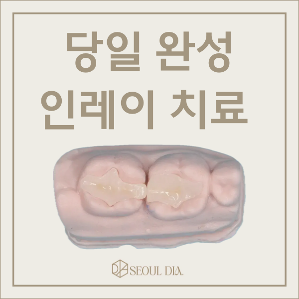 마곡동치과_당일 인레이 치료 과정 관련 이미지 1
