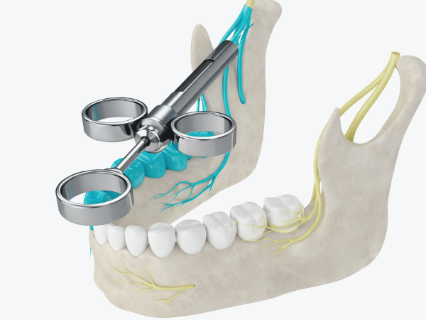 마곡동치과_1. 치과 국소마취, 종류별로 뭐가 다를까요? 관련 이미지 3