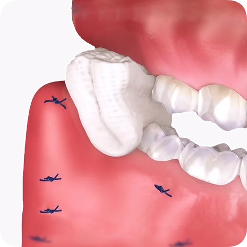 마곡역치과_5. 사랑니 발치 후 주의사항, 잘 뽑았으면, 잘 관리해야죠? 관련 이미지 1