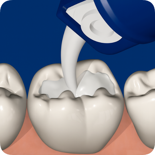 마곡역치과_ 4. 글래스아이오노머(GI) 충치 치료 과정 관련 이미지 4