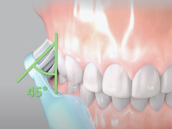 마곡동치과_&ldquo;내려간 잇몸, 더 내려가지 않게 하려면?&rdquo; [4. 치은퇴축 생활 관리법] 관련 이미지 1