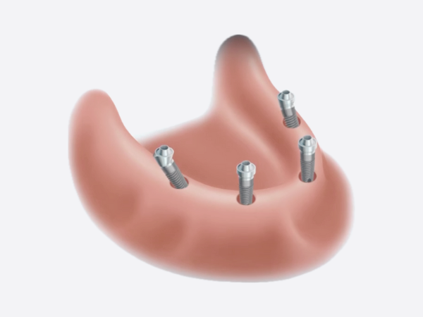 마곡역치과_"상담부터 완성까지" [ 4. 임플란트 틀니 치료 과정 ] 관련 이미지 2