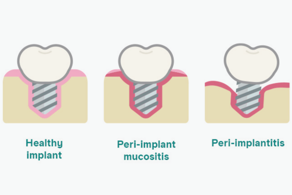 마곡역치과_&ldquo;괜찮겠지?&rdquo; 방심하다가 큰일! [ 1. 임플란트 주위염 3가지 증상 ] 관련 이미지 1