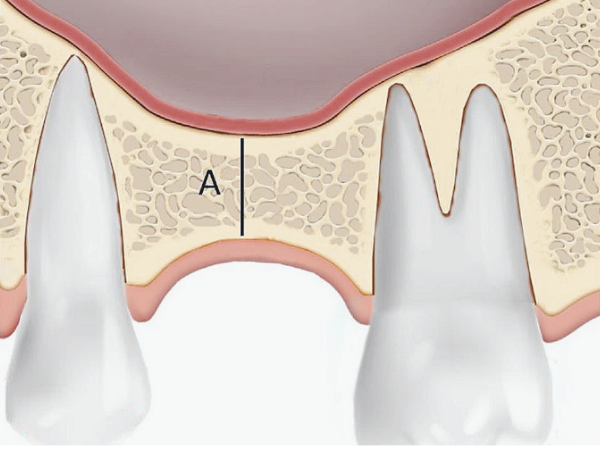 마곡동치과_3. 상악동거상술 없이 임플란트 가능할까요? 되는 조건 정리 관련 이미지 1