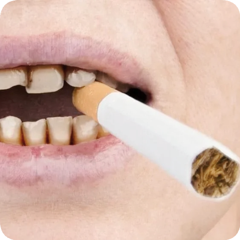 마곡역치과_ 하얀 이가 누렇게 변했다? [ 1. 치아변색의 원인 ] 관련 이미지 4