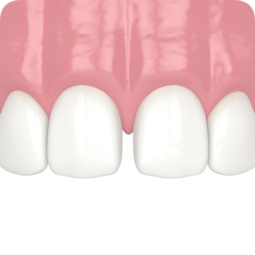 마곡치과_"이럴 땐 레진이 답입니다" [ 1. 치과 레진 활용법 ] 관련 이미지 6