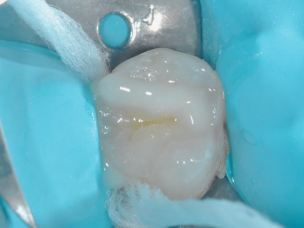 마곡역치과_4. 인레이 치료 후 통증 생기는 이유 [ 자연스러운 회복? 문제 신호?] 관련 이미지 3