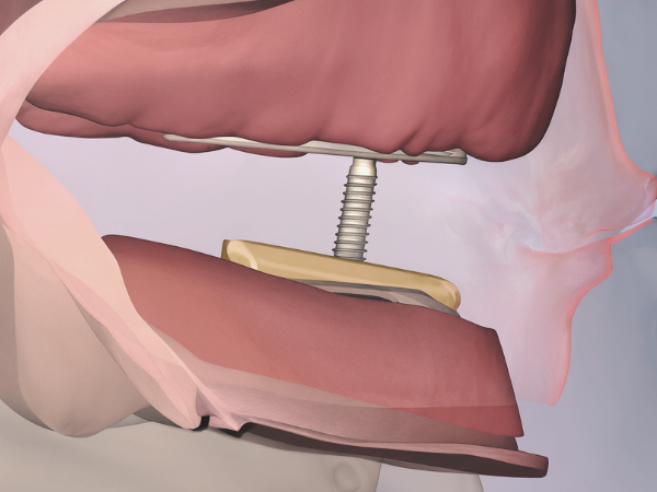 Maggok Station Dental Clinic_“This Is How Dentures Are Completed!” [3. Full Denture Fabrication Process] image 4
