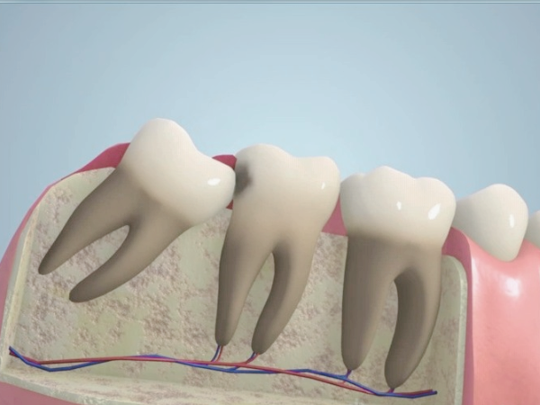 마곡역치과_3. 사랑니 염증 반복되는 이유, 치료해도 다시 불편해질까요? 관련 이미지 1