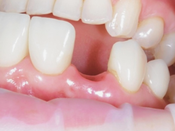 마곡역치과_2. 브릿지 치료, 누가 하면 좋을까요? 가능한 경우와 판단 기준 정리 관련 이미지 2