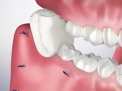 마곡동치과_9. 사랑니 발치 후 음식, 이렇게 드셔야 회복도 빠릅니다. 관련 이미지 1