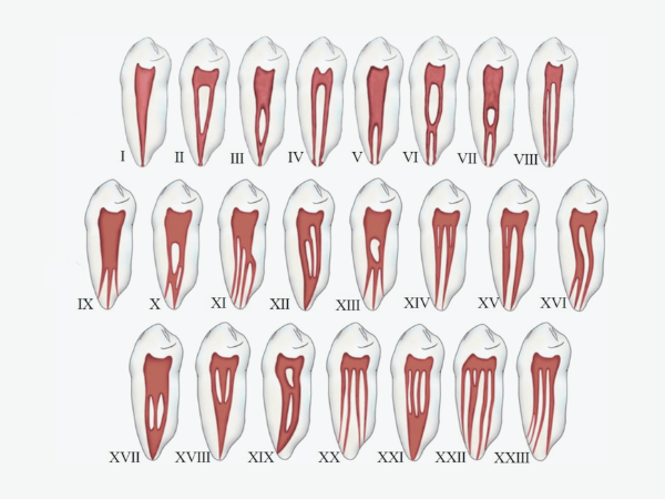마곡역치과_3. 신경치료 후 통증, 오래가는 경우는 따로 있습니다 관련 이미지 4