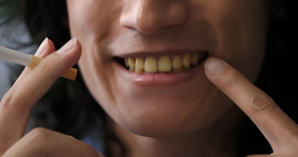 [ Magok Teeth Whitening_03 ] When Is Teeth Whitening Effective—and When Is It Not? image 2