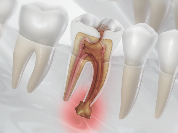 마곡치과_1. 씹을 때 치아 통증, 왜 생길까요? 관련 이미지 3