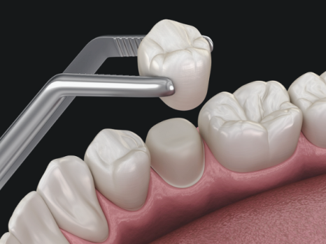 [ Magok Implants_07 ] Implant Prostheses: What’s the Difference Between Zirconia and PFM? image 1
