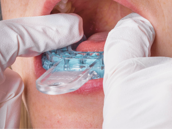 마곡동치과_3. 브릿지 치료는 어떻게 진행될까요? 실제 과정 순서대로 정리 관련 이미지 3