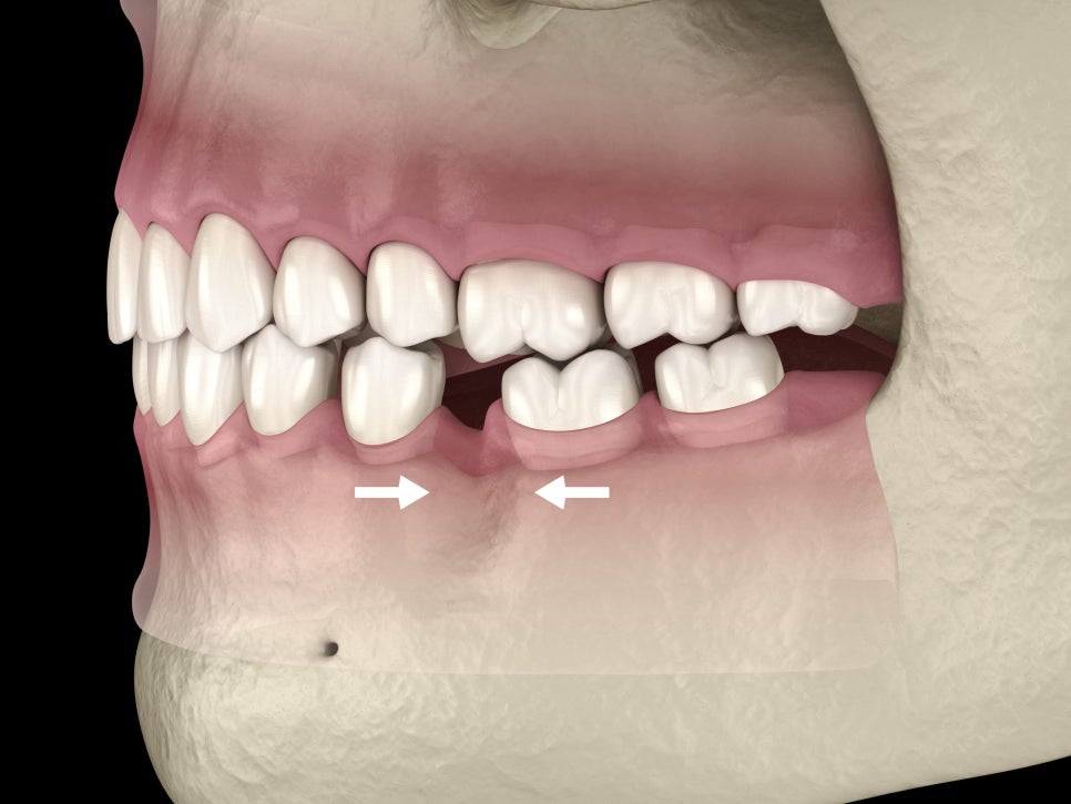 마곡동치과_1. 브릿지 치료란 무엇인가요? 임플란트, 틀니와 차이부터 정리합니다 관련 이미지 1