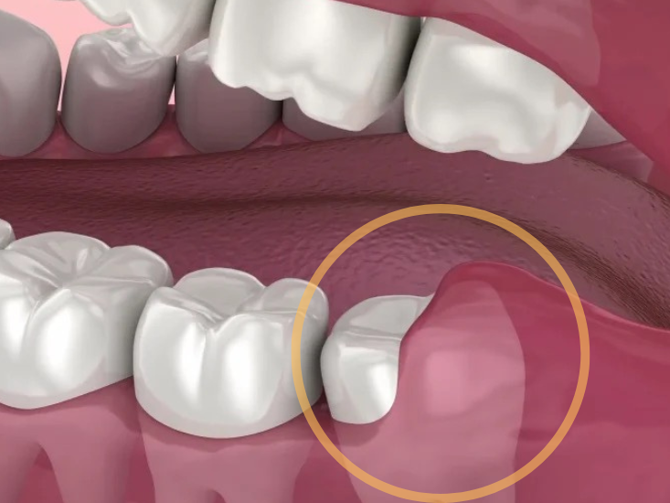 마곡동치과_1. 사랑니염증 원인, 왜 유독 사랑니만 문제를 만들까요? 관련 이미지 3