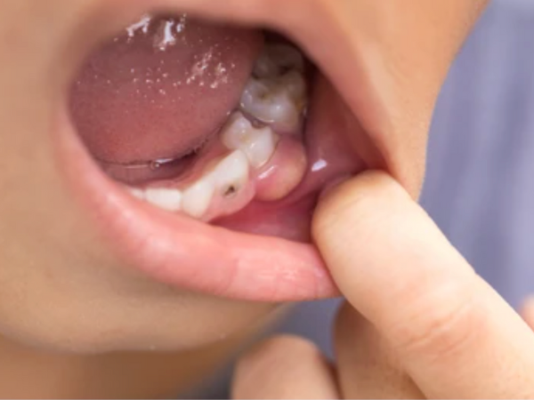 마곡역치과_ 2. 글래스아이오노머(GI) 적응증 관련 이미지 2